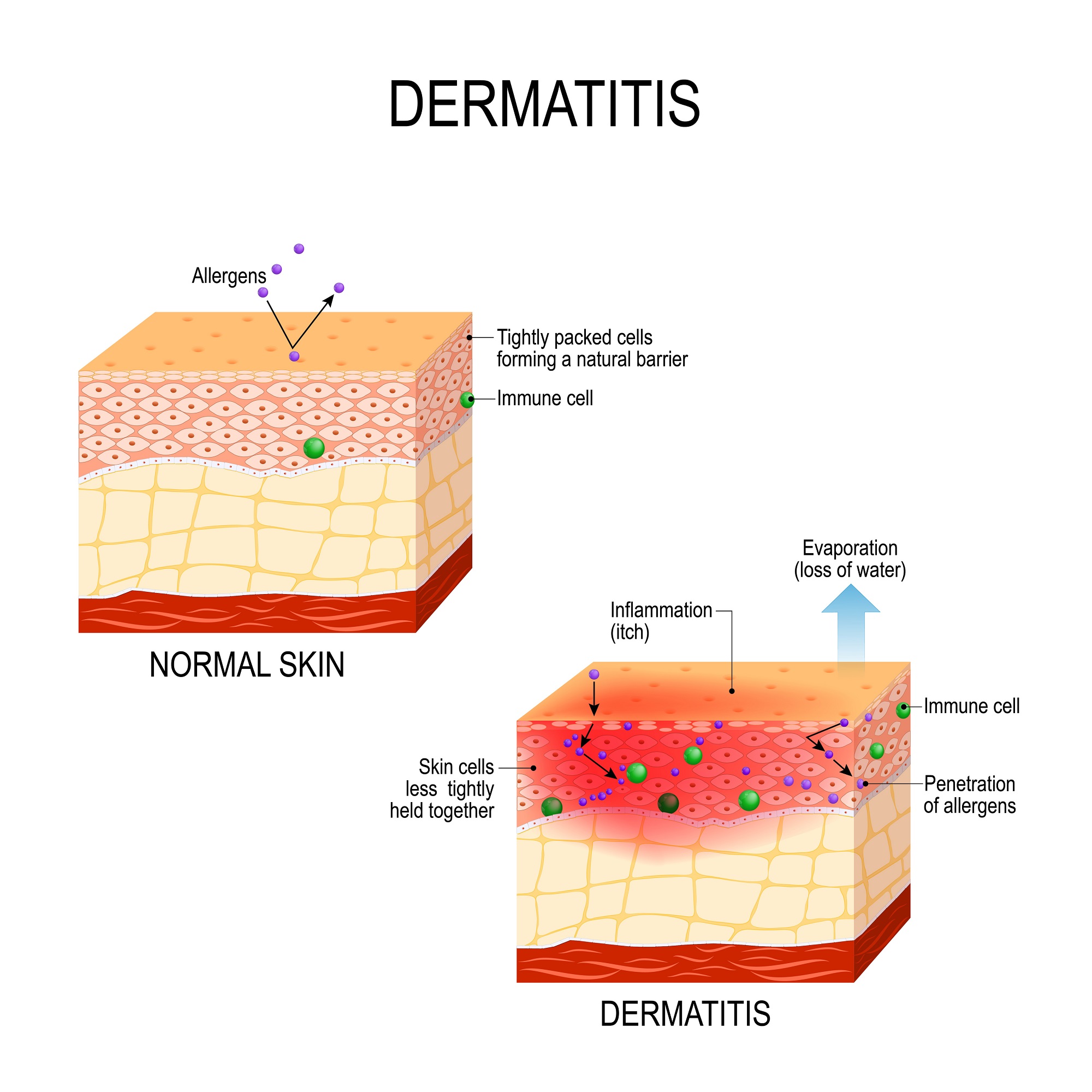 Cos è la dermatite atopica e quali trattamenti sono più indicati TrendingResults com